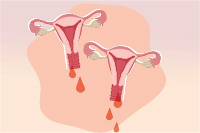 解析子宫功能性出血：了解原因与治疗