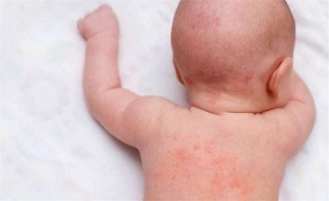 儿童接触性皮炎：引发原因及护理建议