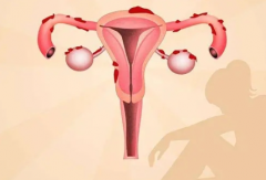 子宫脱垂恢复指南：四种科学方法助你重拾健康