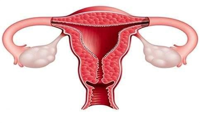 探秘子宫内膜异位症：了解症状，及早治疗