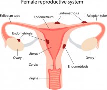 探秘子宫内膜异位症：了解症状，及早治疗