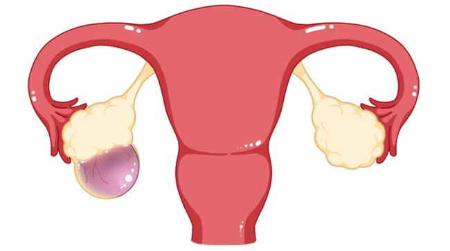 卵巢囊肿：到底需要手术吗？一位专家给你答案！