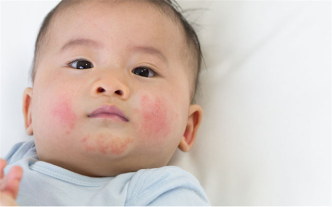 宝宝湿疹：细致呵护的必要性