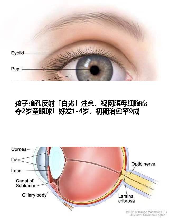 孩子瞳孔反射「白光」注意，视网膜母细胞瘤夺2岁童眼球！好发1-4岁，初期治愈率9成