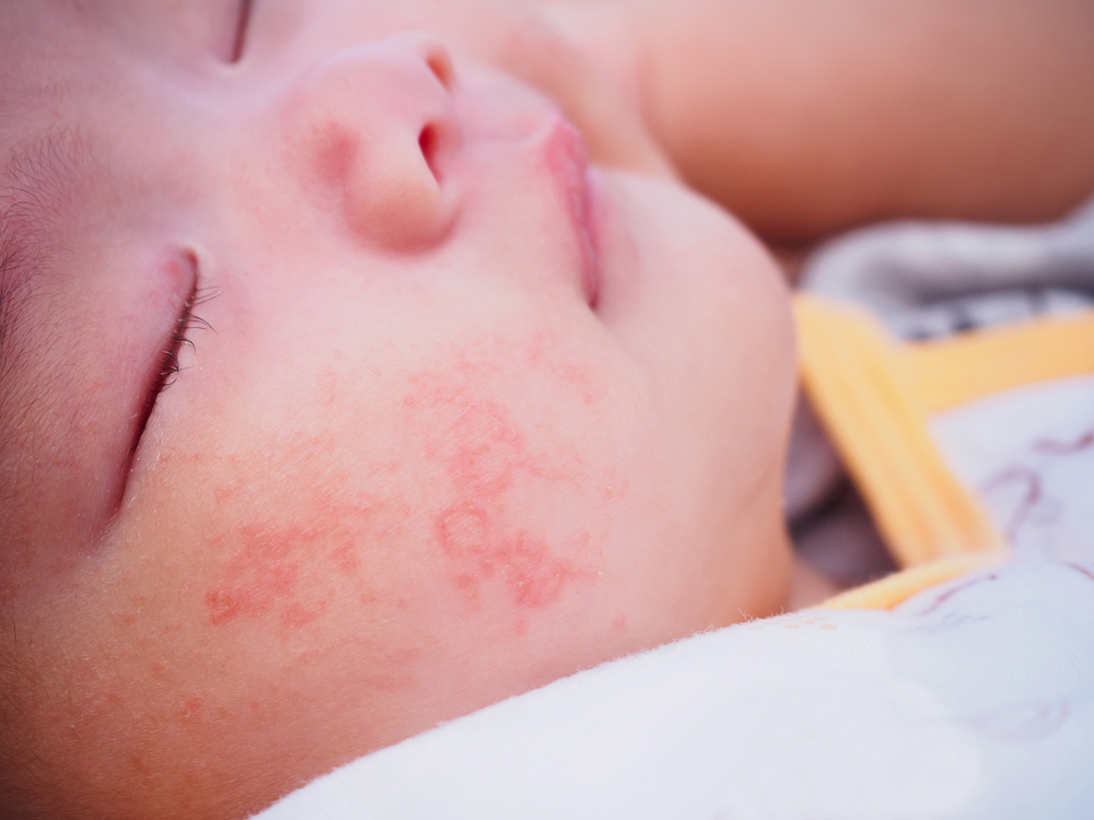 母乳喂养对婴儿的皮肤有危险吗?