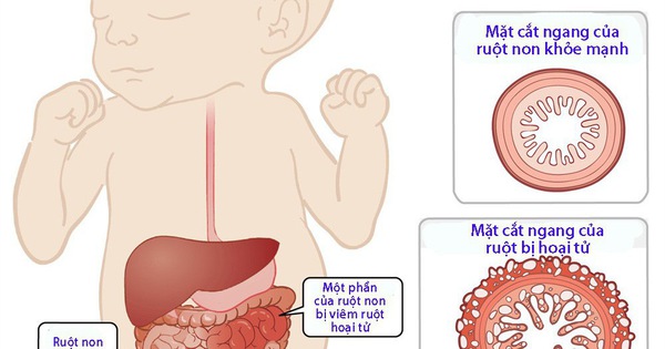 婴儿坏死性小肠结肠炎有危险吗?
