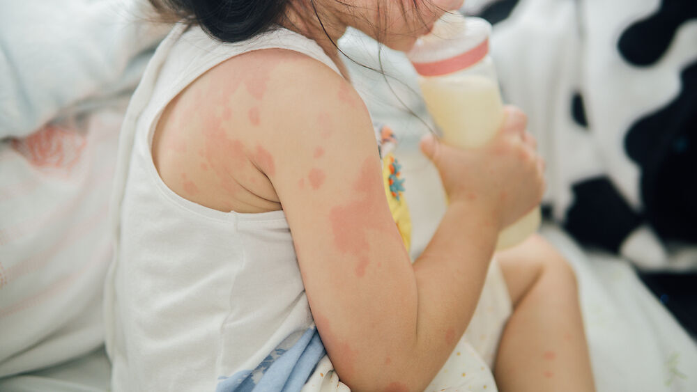 如何安全有效地处理儿童牛奶过敏