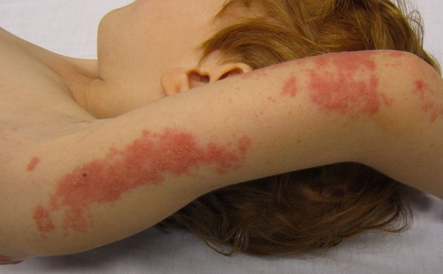 6种让孩子在皮肤上漂浮的疾病,不要小看
