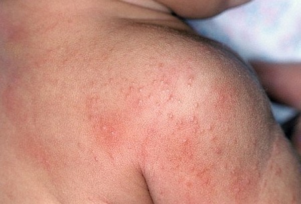 婴儿皮炎: 如果母亲不及早治愈,婴儿容易出现并发症