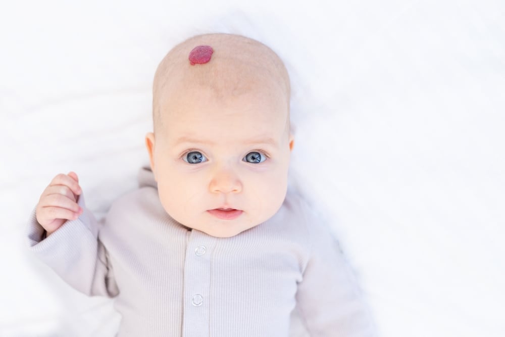 婴儿头部脂肪瘤: 良性还是恶性?