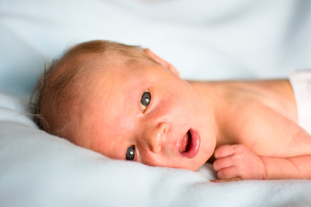 什么是婴儿黄疸?原因,治疗