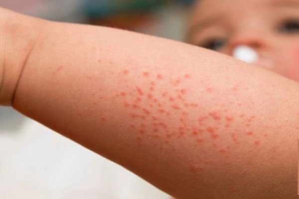 儿童神经带状疱疹,罕见但非常危险!