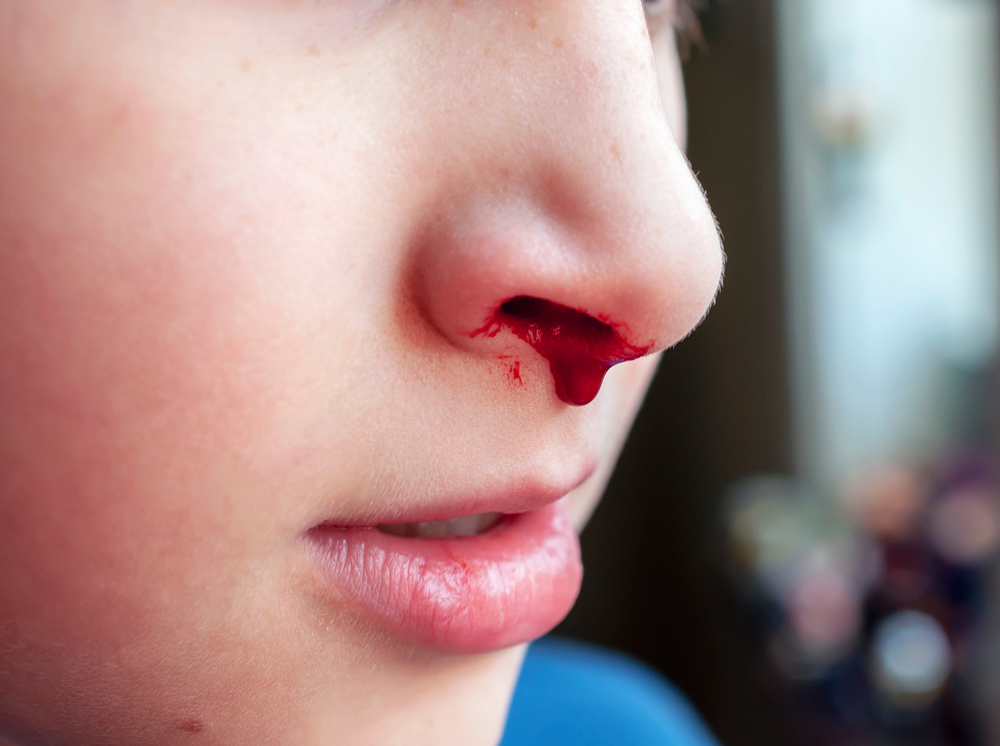 儿童流鼻血是怎么回事?父母需要知道的有效和安全的急救方法