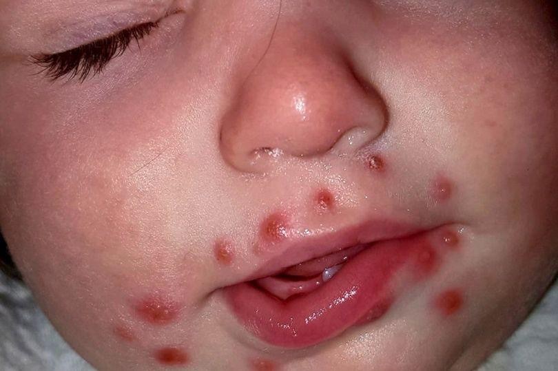 6种让孩子在皮肤上漂浮的疾病,不要小看