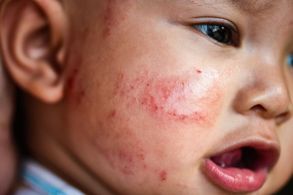 新生儿15种常见皮肤病