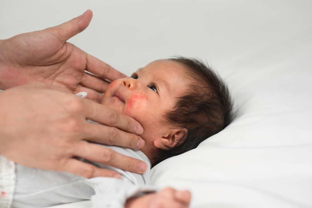 母乳喂养对婴儿的皮肤有危险吗?