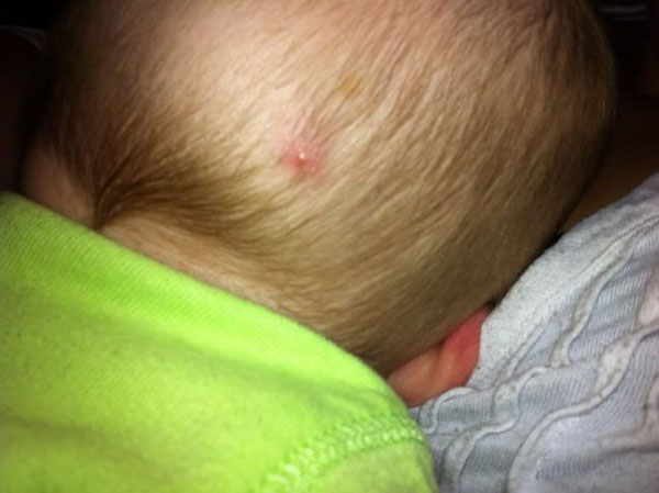 婴儿头上有脓疱危险吗?