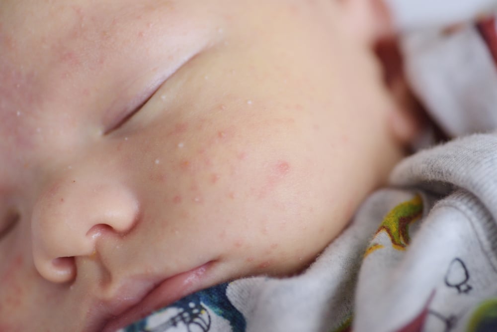 如何安全地治疗儿童丘疹并在5天后立即消除