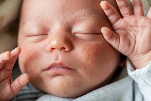 宝宝脸上红疹是怎么回事?原因和治疗