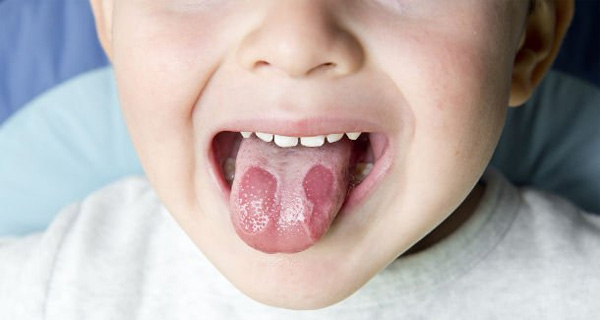 儿童地图舌炎有危险吗?