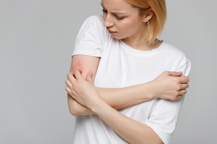 「荨麻疹」怎么止痒？症状为何？皮肤科医师教你3种舒缓方式、止痒饮食技巧