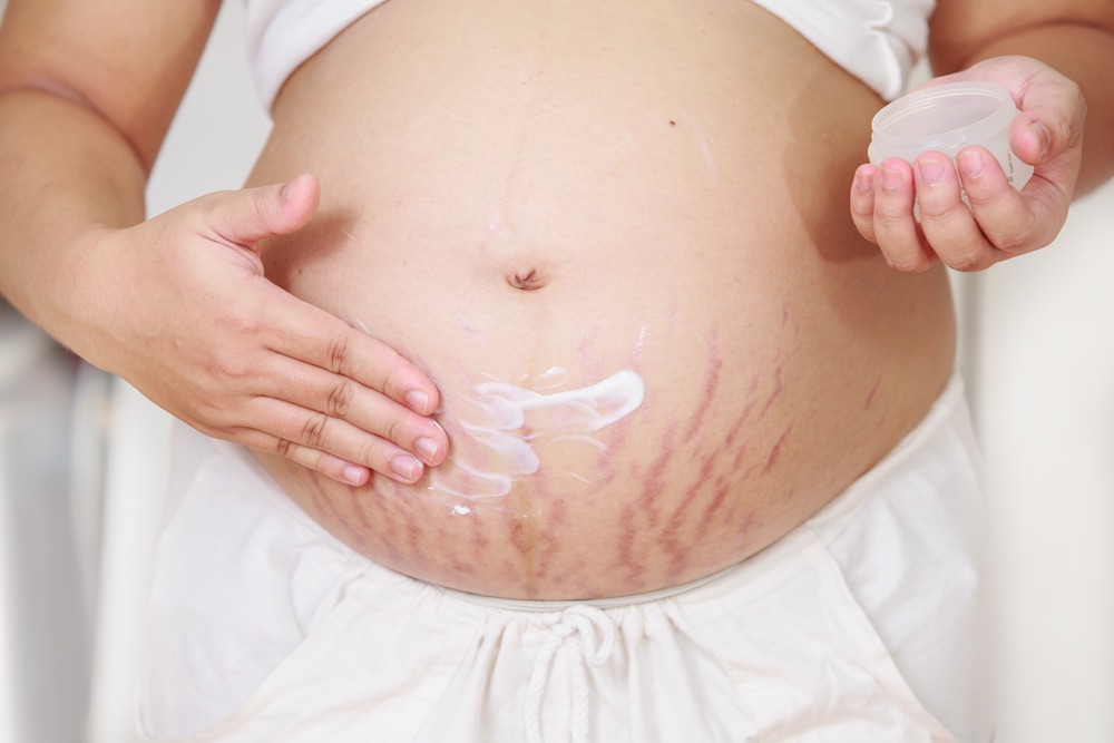养成擦乳液习惯就能避免妊娠纹！3招预防孕期恼人的妊娠纹