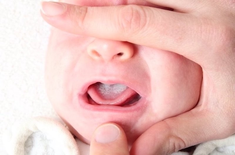 婴吐黄绿色奶、体重异常减轻⋯恐患「肠旋转不良症」