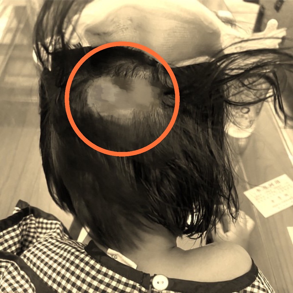 3岁女童摔后脑勺需缝四针！幼儿园辩孩子受伤是因为「个性像妈妈一样急」