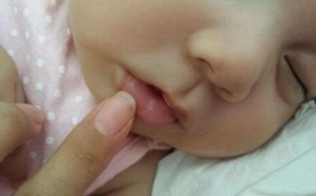 婴幼儿常见病：宝宝鹅口疮如何预防和治疗