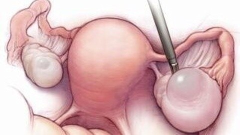 什么是卵巢囊肿？是否影响怀孕？