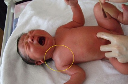 什么是新生儿产伤？新生儿产伤该如何护理？