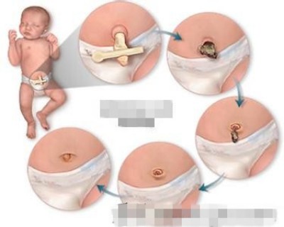 新生儿护理脐炎怎么治疗？新生儿脐炎护理的四个重点