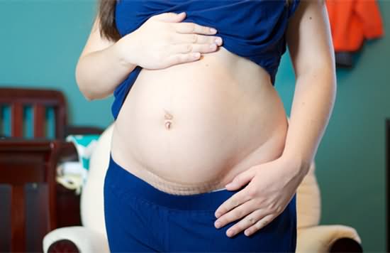 孕妇剖腹产 如何让腹部恢复平坦？