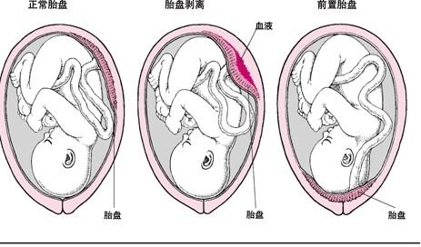 3秒弄懂胎盘前置和胎盘前壁的区别