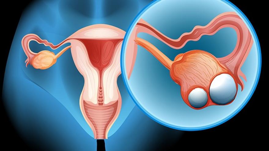 卵巢癌晚期怎么办