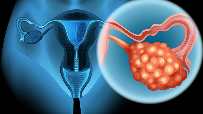 卵巢癌复发怎么办