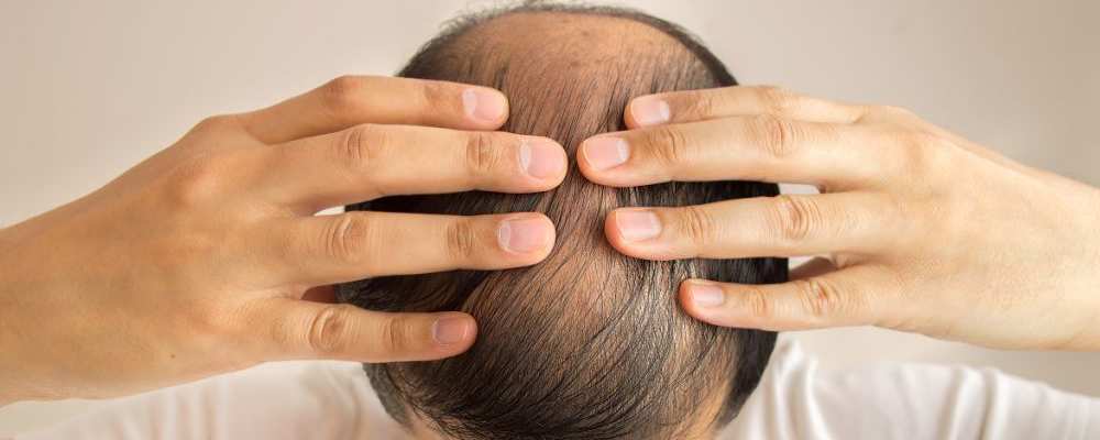 洗热水会导致脱发吗 如何防止脱发