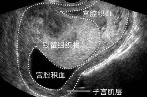 产后恶露是什么多久干净 造成恶露不尽的原因有四种可能