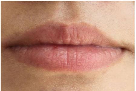 嘴唇上长水泡是什么原因,快速消除水泡的两个方法