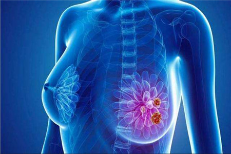 乳腺癌常见的原因以及症状