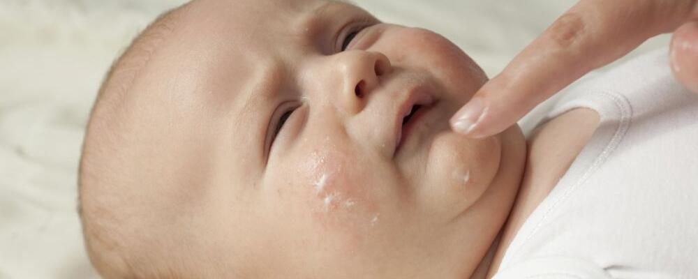 新生儿湿疹怎么办 为什么会长湿疹