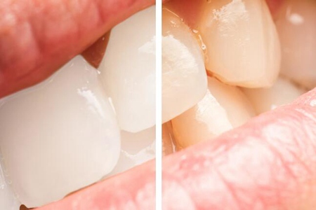 洗牙对牙齿有伤害吗？洗牙的好处和坏处