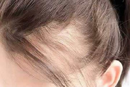 女人经常脱发的原因以及预防方法