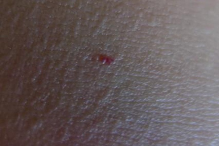 身体上有小红点是什么病？这3种疾病会引发皮肤上有小红点