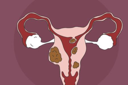 女人预防子宫肌瘤注意做好三件事