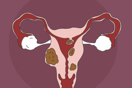 子宫肌瘤发病原因以及预防的方法