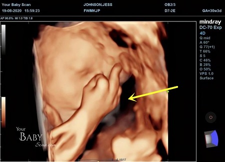 英国孕妇38周做彩超,胎儿动作让准爸妈哭笑不得,一看就是淘气包