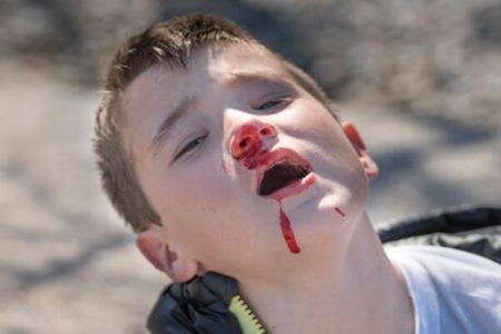小孩子流鼻血是什么原因？这五个原因造成及时调整