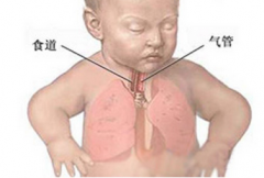 【新生儿肺不张的原因】_新生儿肺不张的症状